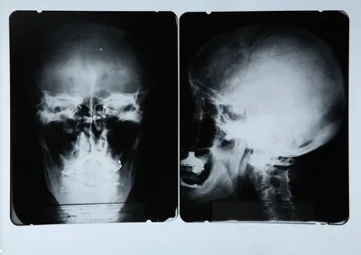 Рентген черепа для диагностики опухолей