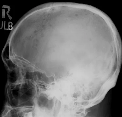 Фото рентгена черепа в черно-белом стиле