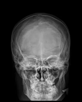 Фото черепа в рентгеновском излучении с описанием