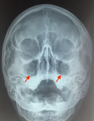 Картинка черепа в рентгеновском излучении с аннотацией