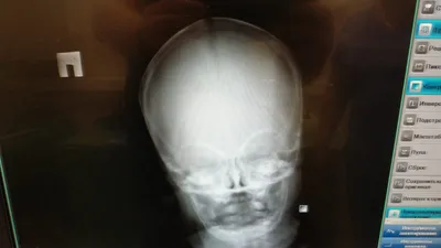 Фотография Рентген черепа