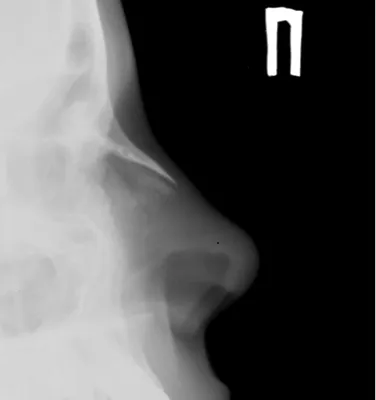 Череп человека на рентгене