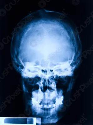 Рентген черепа для медицинских целей