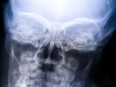 Картинка рентгена черепа для диагностики
