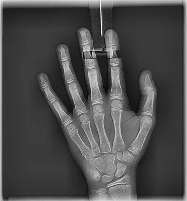 Изображение рентгена кисти руки в формате JPG