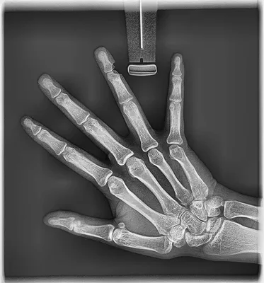 Скачать рентген кисти руки в формате WebP