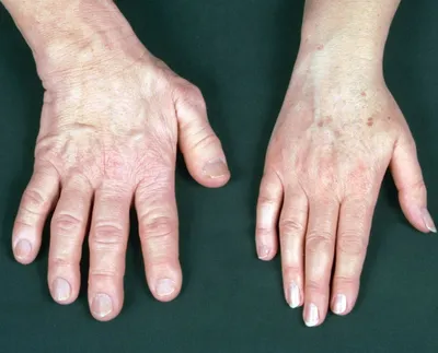 Изображение рентгена кисти руки: как правильно расшифровать результаты