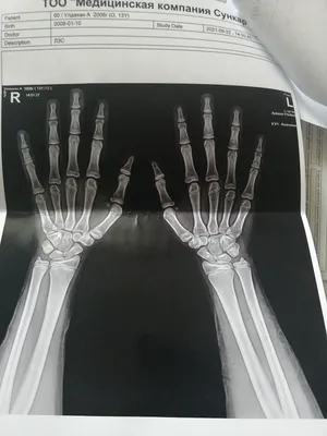 Фото рентгена кисти руки в высоком разрешении