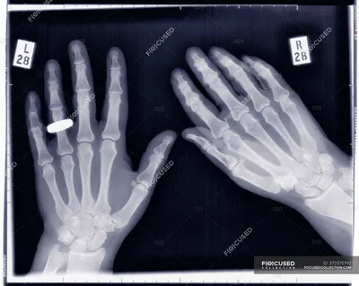 Рентгеновская фотка руки для медицинских целей