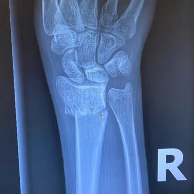 Рентгеновская фотография руки для диагностики