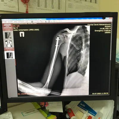 Фотография руки на рентгене в PNG