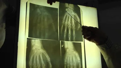 Рентгеновская фотка руки с подписями