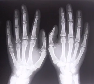 Рентгеновская фотография руки в формате JPG