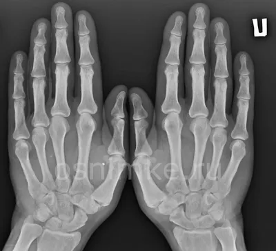 Рентгеновская фотография руки с фрактурами
