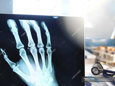 Рентгена руки фотографии
