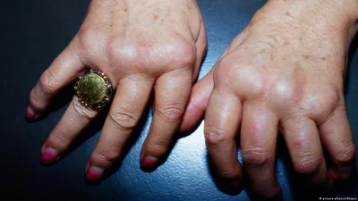 Ревматоидный артрит руки фотографии