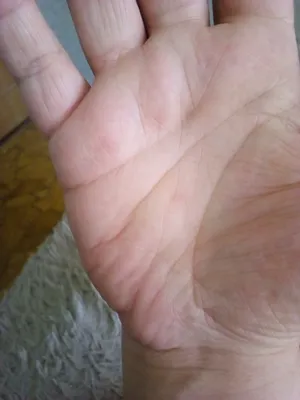 Фотография рук с деформациями из-за ревматоидного артрита для обучения медицинских работников