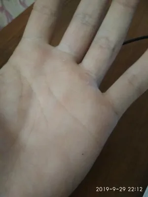 Фото рук с признаками ревматоидного артрита для сравнения степени развития болезни