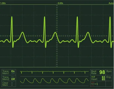 Ритм сердца, электрокардиограмма, ECG - сигнал EKG, Pu сердцебиения  Иллюстрация вектора - иллюстрации насчитывающей диаграмма, частота:  131340261