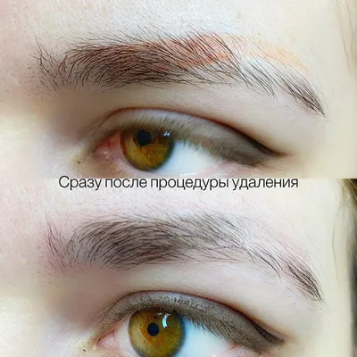 Родинка татуажа на груди