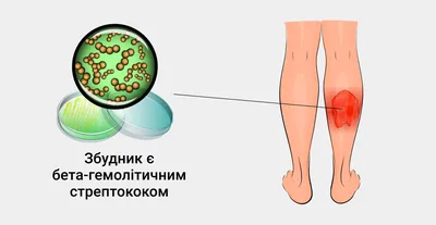 Рожа на руке лечение фотографии