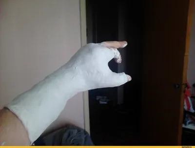 Рука в гипсе: изображение для статей о травмах