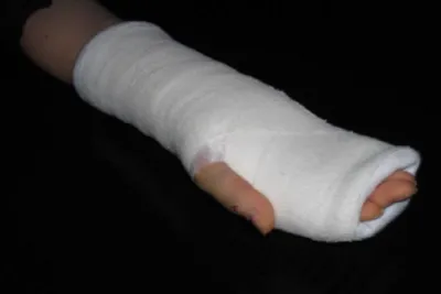 Картинка руки в гипсе: фотография для статей о лечении травм