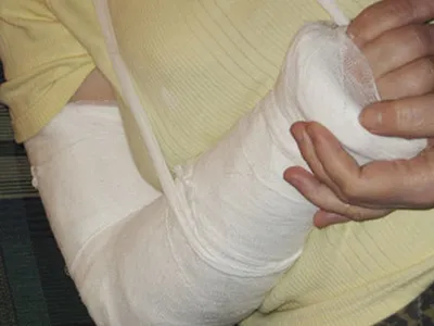 Фото руки в гипсе: изображение для статей о реабилитации после травм