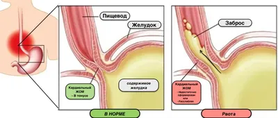 Рвота у ребенка. Как распознать хирургическое заболевание? | Со слов  Детского Хирурга | Дзен