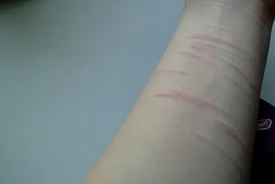 Боль и страдание: изображение с порезами на руках