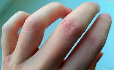 Фотография рук с шелушащейся кожей и потрескавшейся кожей
