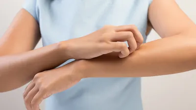 Фотография рук с шелушащейся кожей и аллергической реакцией