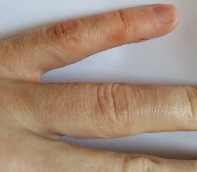 Изображение рук с шелушащейся кожей и дерматитом