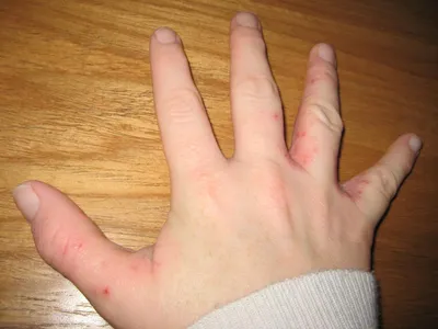 Фотография рук с проблемной кожей и пузырьками