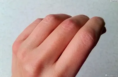 Изображение рук с шелушащейся кожей и микозом