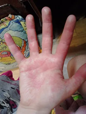 Фото с шелушащейся кожей на руках и мокнутием