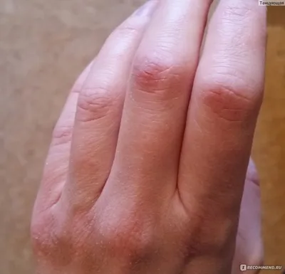 Руки с шелушащейся кожей: фотография для диагностики