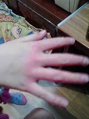 Руки с шелушащейся кожей: фотография в замедленной съемке