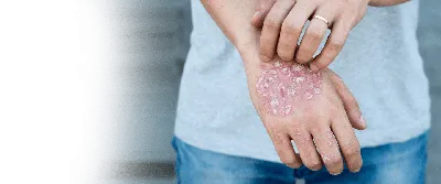 Фото рук с шелушащейся кожей: глубокий кадр