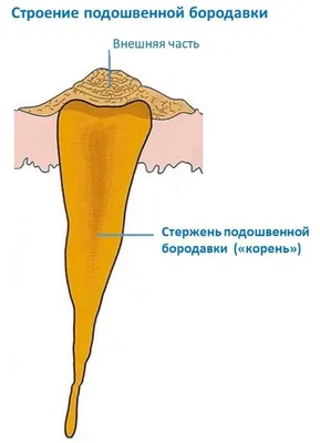 Пластырь H Dr.House Мозольный - «Как избавиться от подошвенной бородавки ( шипицы, куриной жопки) Мой отзыв! Спасение ЕСТЬ!» | отзывы