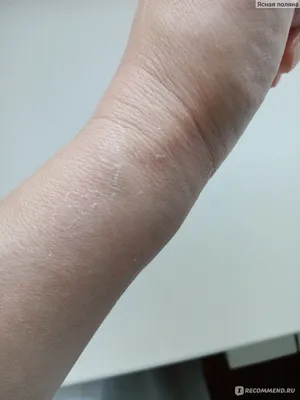 Фотография шишки на запястье левой руки для скачивания в PNG