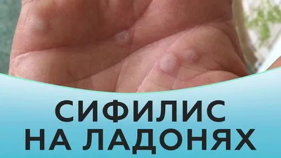 Фото шишек на пальцах рук: бесплатно и без ограничений