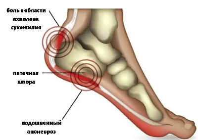 Шпоры на ногах картинки фото