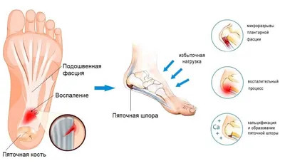 Пяточная шпора | Симптомы | Диагностика | Лечение - Lik.ua