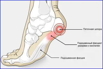 Пяточная шпора: симптомы и лечение | Клиника Temed