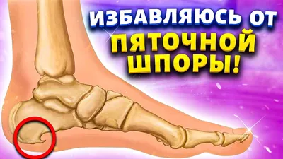 Шпоры на пятках: все методы медикаментозного лечения | Шпильки | Дзен