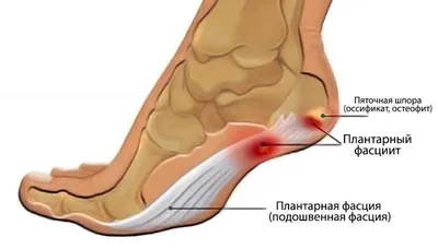 Делаю это на ночь и забыла о пяточной шпоре. Плантарный фасциит. Больные  ноги превращает в здоровые. - YouTube