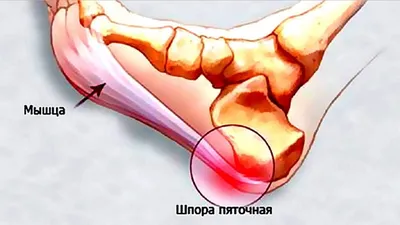 Симптомы пяточной шпоры, методы лечения – что нужно знать пациенту —  клиника «Добробут»