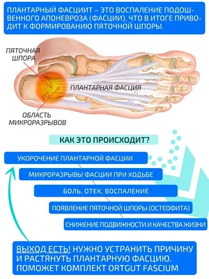 Ударно-волновая терапия пяточной шпоры.Причины возникновения шпор