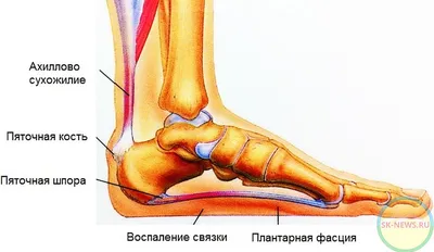 Лечение пяточной шпоры